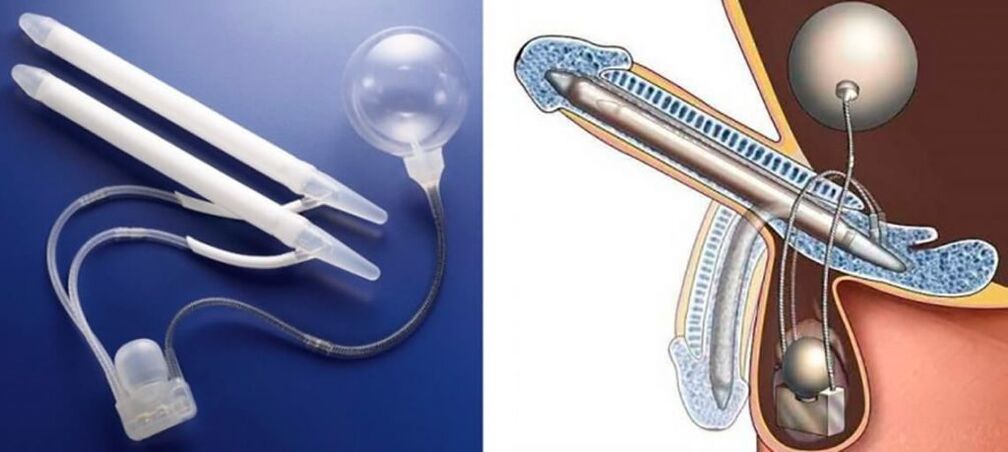 Penile prosthesis alang sa pagpalapad sa penis