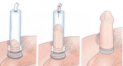 Pagpadako sa penis gamit ang bomba
